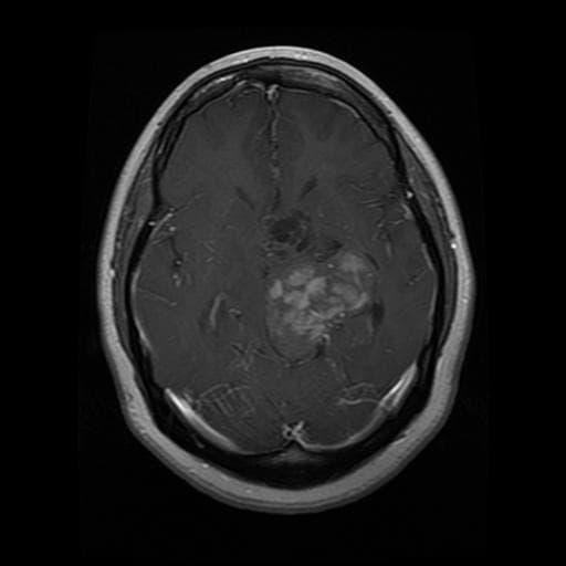Axial brain MRI slice showing a glioma